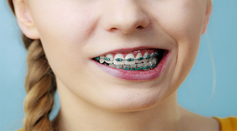 8 tác hại có thể xảy ra khi niềng răng giá rẻ