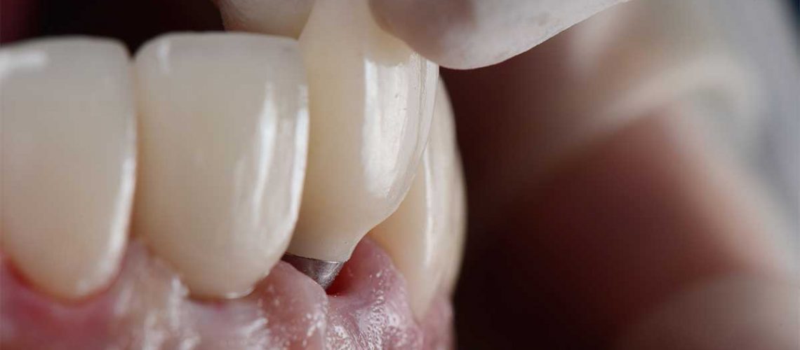 Vật liệu cấu tạo trụ Implant không tương thích sẽ gây đau sau khi trồng răng Implant
