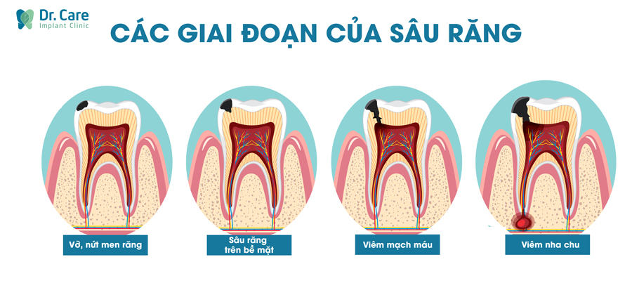 Các giai đoạn phát triển của sâu răng