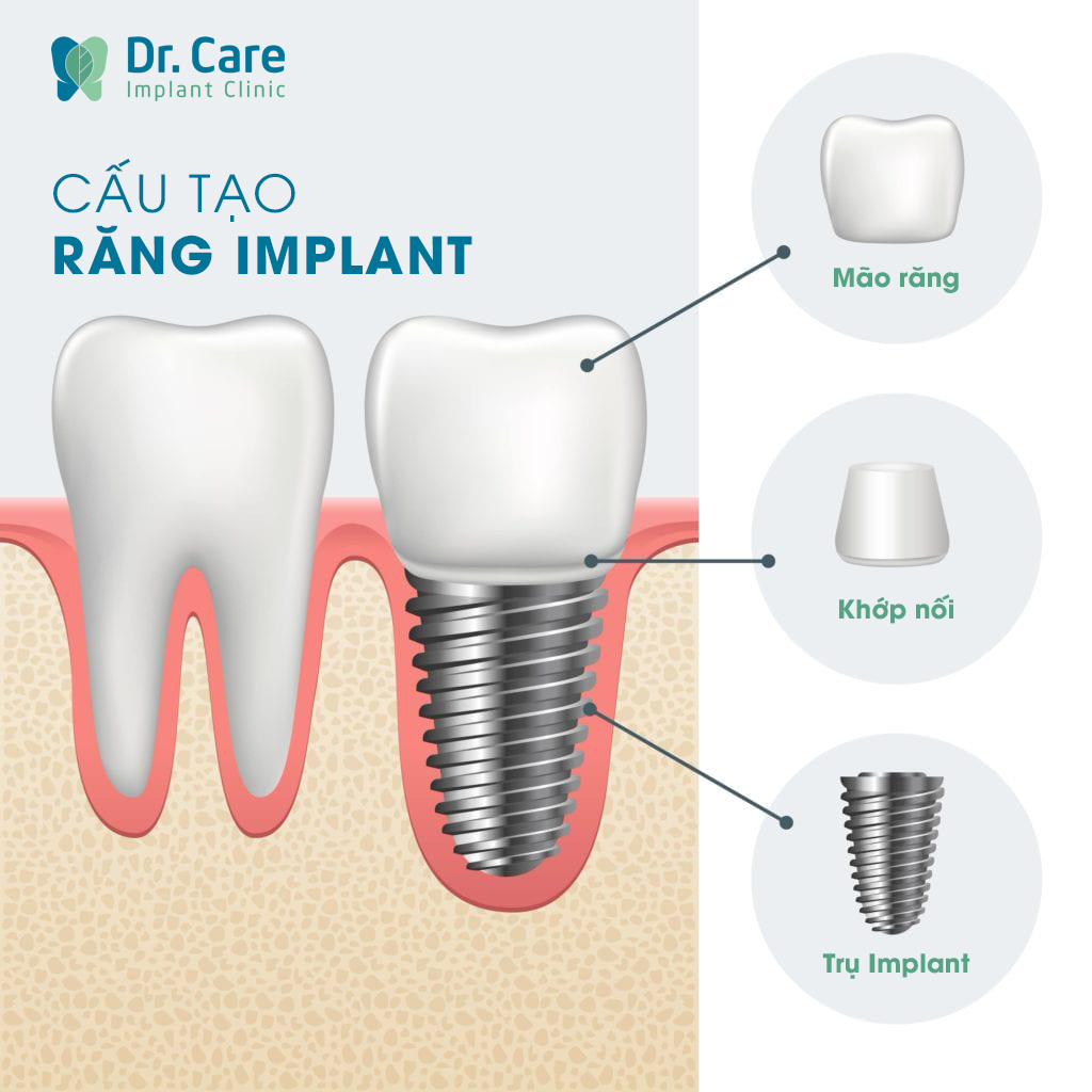 Trồng răng Implant là gì? Cấu tạo răng Implant