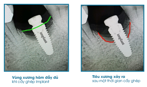 Biểu hiệu muộn của trồng răng Implant thất bại
