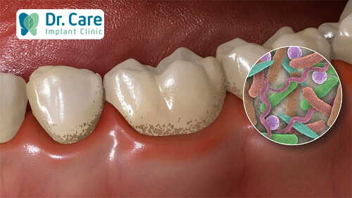 Các triệu chứng khi răng bị đen ở kẽ sẽ là gì?