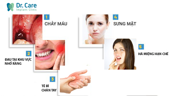 Những triệu chứng thường gặp sau khi nhổ răng khôn