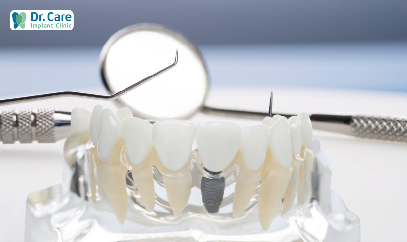 7 tiêu chí giúp xác định địa chỉ trồng răng Implant tại TPHCM uy tín, chất lượng