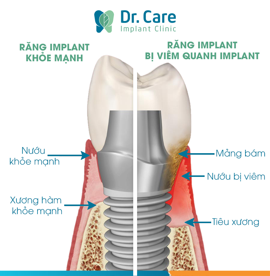Viêm quanh Implant là gì?