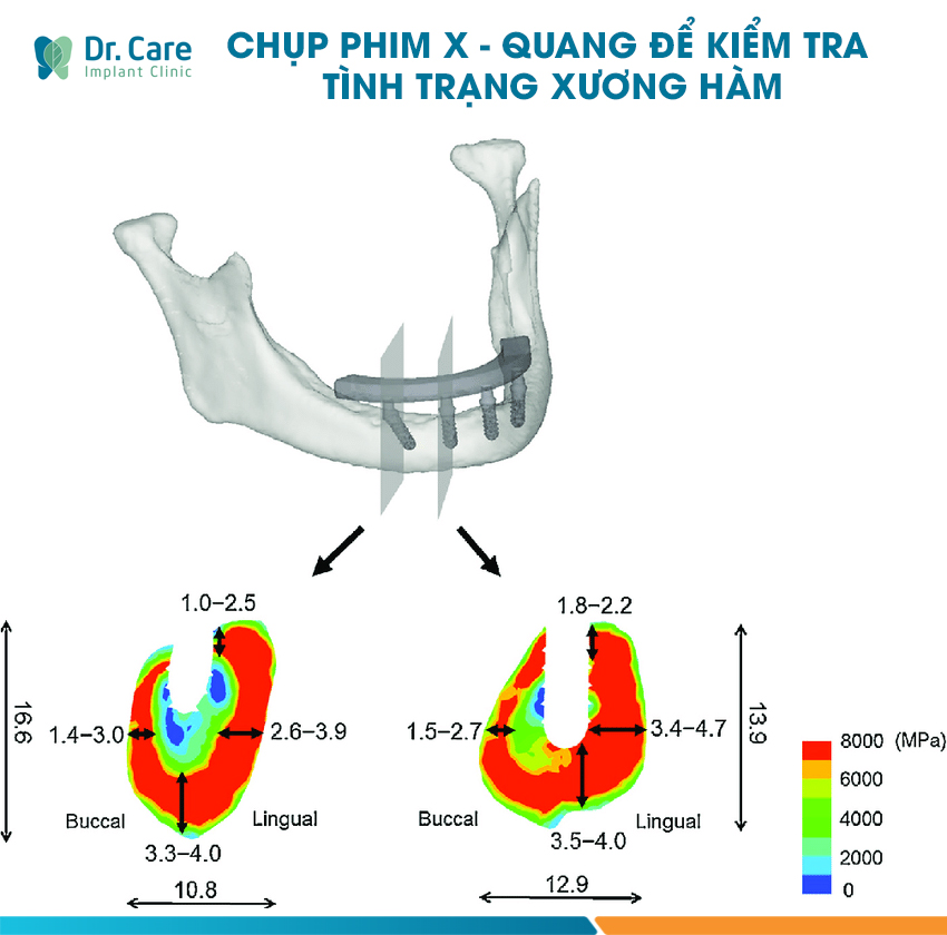 Chụp phim X - Quang để kiểm tra tình trạng tiêu xương hàm