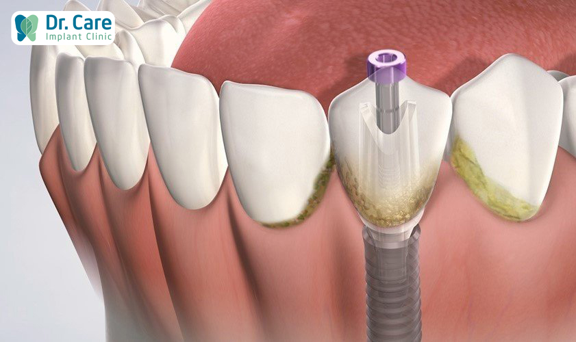 Khả năng vệ sinh răng miệng kém sau cấy ghép Implant