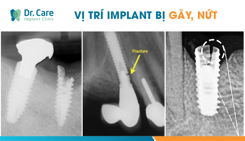 Trụ Implant không phù hợp với kích thước xương hàm và phương pháp phục hồi