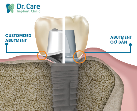 Customized Abutment trong trồng răng Implant là gì?