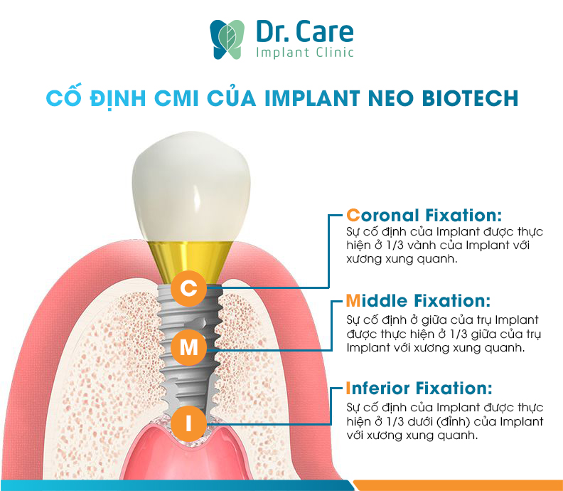 Thiết kế hoàn hảo tăng tính ổn định cho trụ Implant Neo Biotech