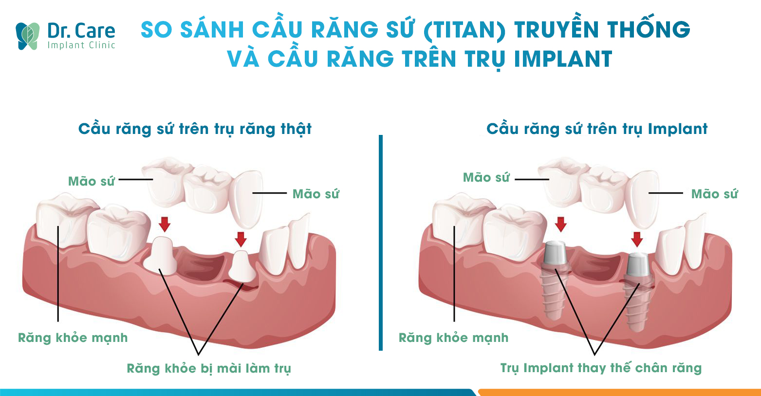 Cầu răng sứ trên trụ Implant
