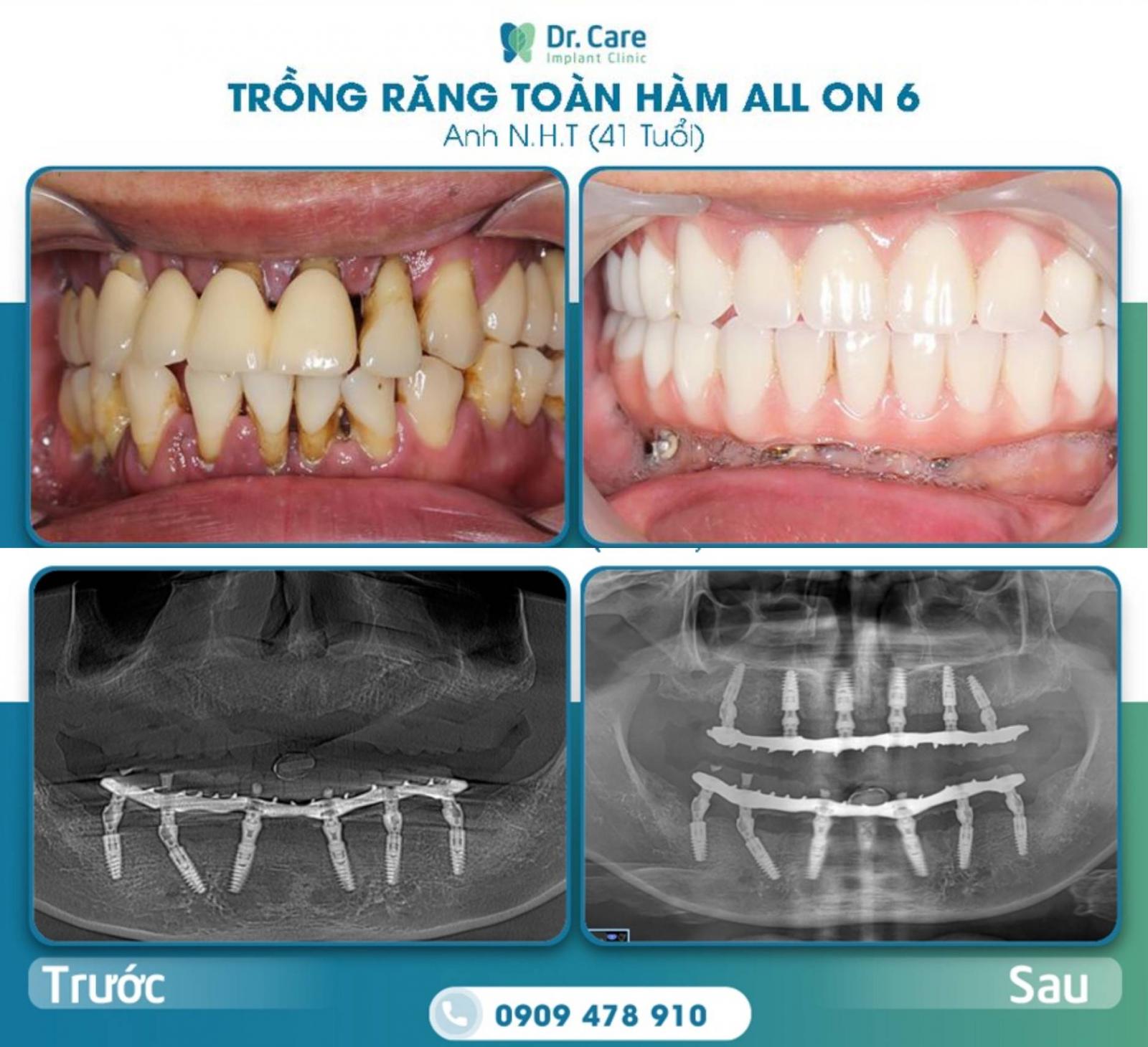 Ưu điểm của trồng răng Implant toàn hàm All on 4 