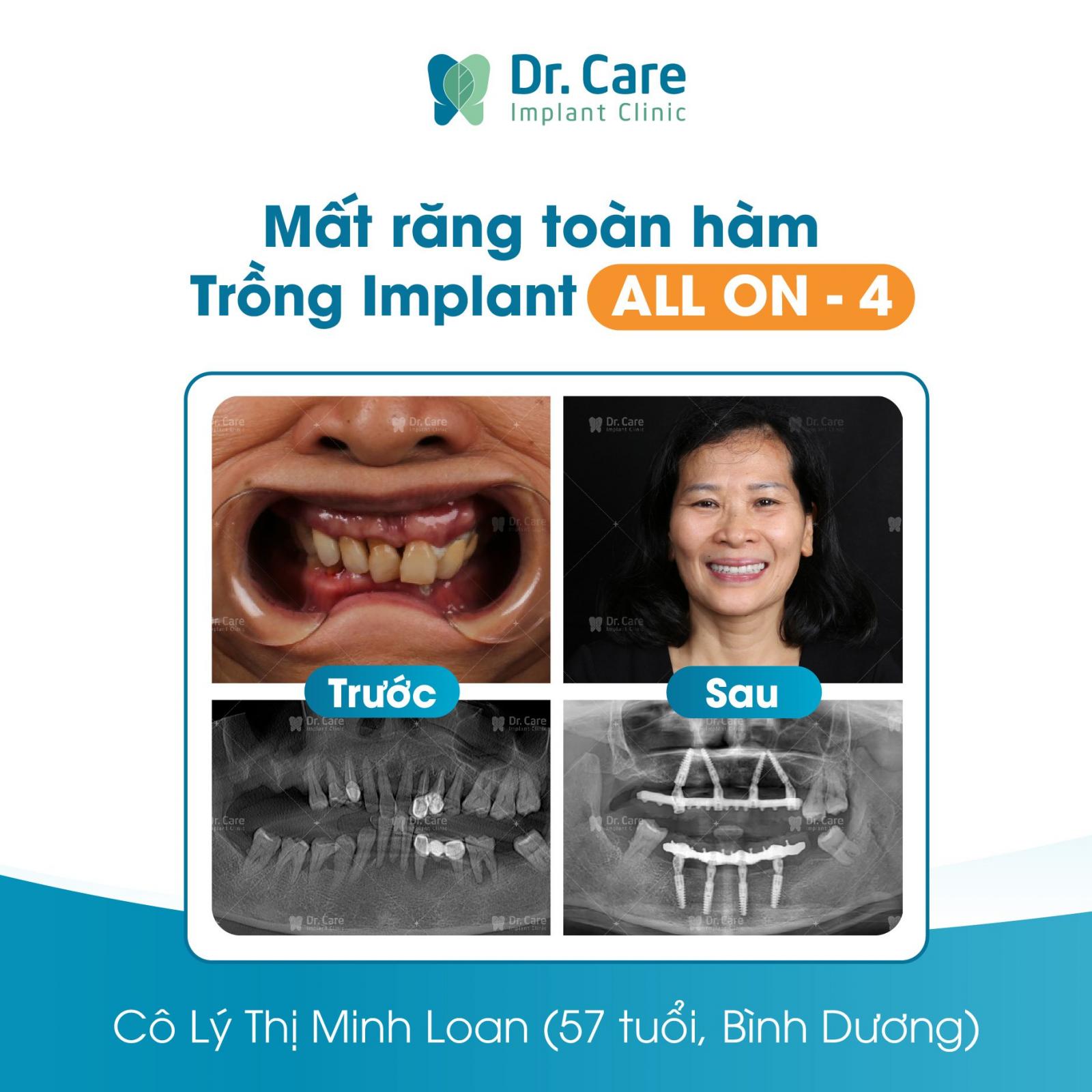 Trồng răng toàn hàm Implant All On - 4 