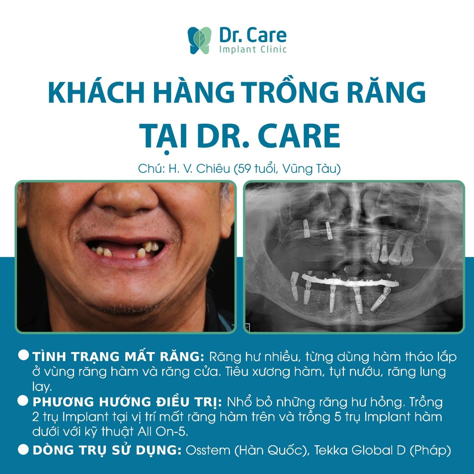Top 10 địa chỉ trồng răng Implant uy tín tại TP.HCM | Dr. Care 1