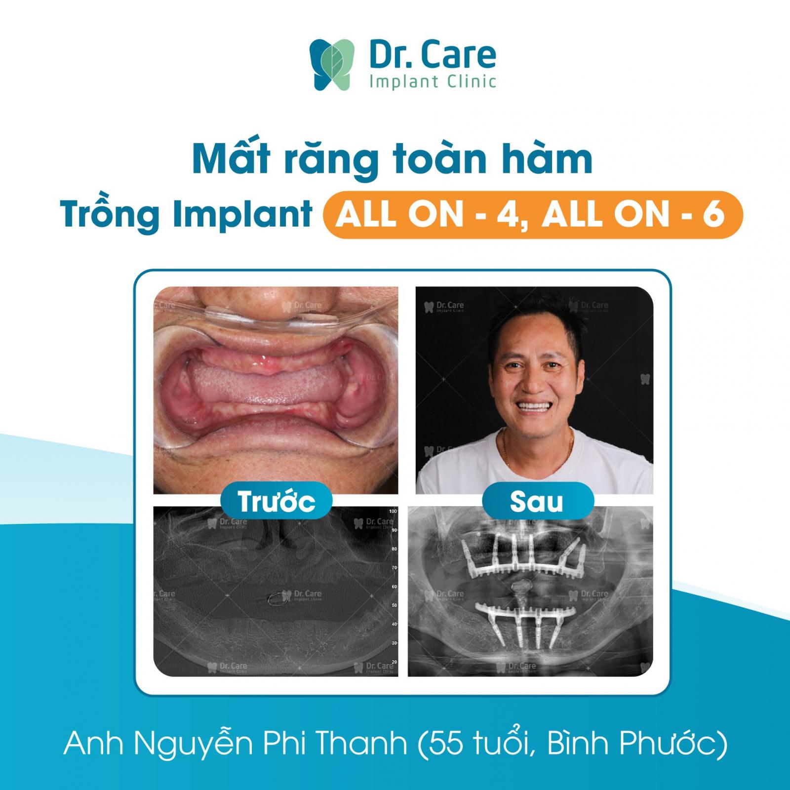 Trồng răng toàn hàm Implant All On - 6 tại Dr. Care