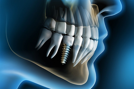 Đau răng sau khi trồng Implant có nguy hiểm không?