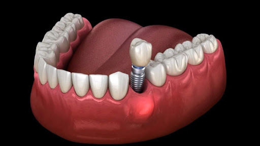 Đau răng sau khi trồng Implant có nguy hiểm không?