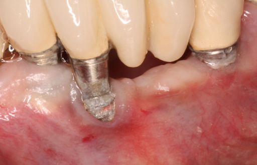 Nguyên nhân gây đau răng sau khi trồng Implant