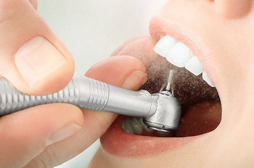 Quy trình trám răng tại các phòng khám nha khoa