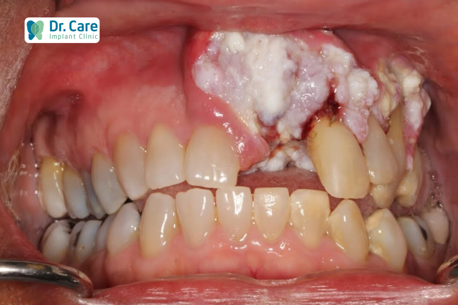 Ung thư nướu răng là gì?