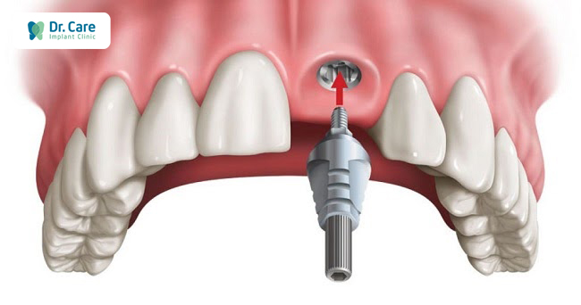 cầu răng sứ và trồng răng implant