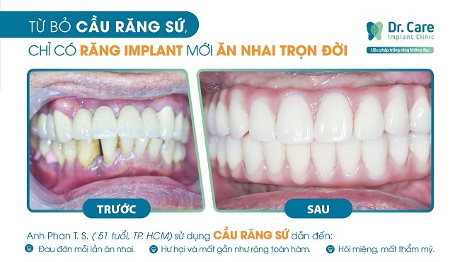 cầu răng sứ và trồng răng Implant