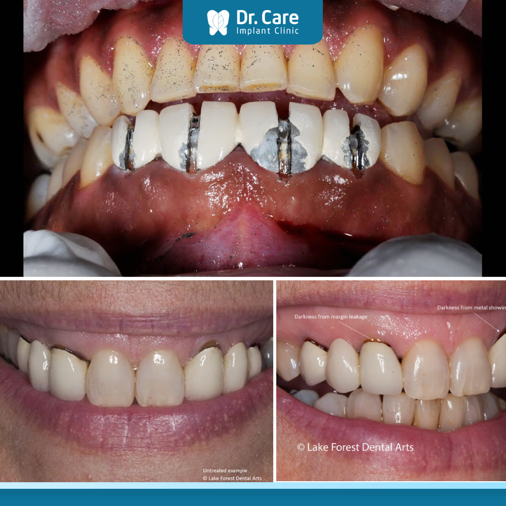 Bọc răng sứ Titan có thể bị đen đi sau một thời gian nhất định