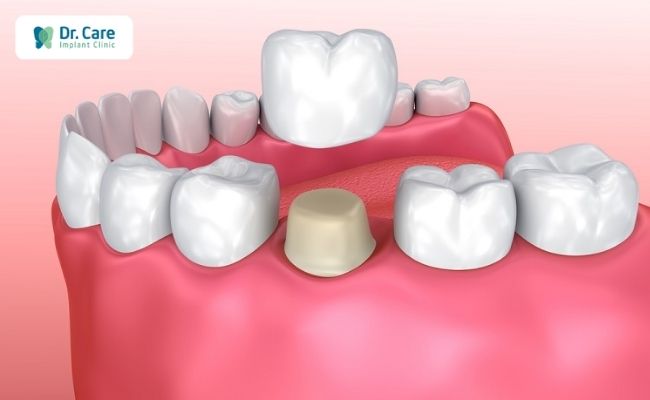 Bọc răng sứ là gì? Bọc răng sứ bị hở nguyên nhân do đâu?
