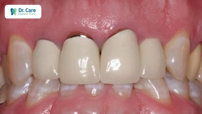 Tác hại của việc bọc răng sứ bị hở