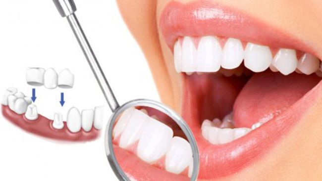 Lệch khớp cắn do phục hồi răng sai kỹ thuật