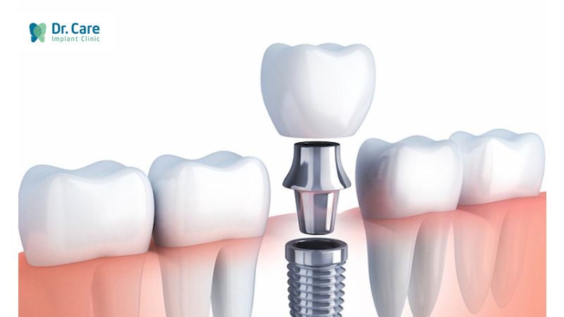 Có nên sử dụng dịch vụ trồng răng Implant trả góp hay không?