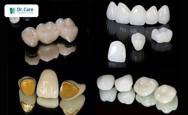 Các loại răng sứ trên thị trường