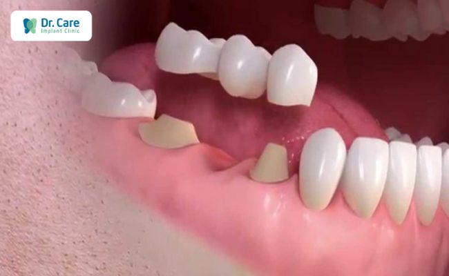 Phương pháp cầu răng sứ là gì? Những ai cần làm cầu răng sứ