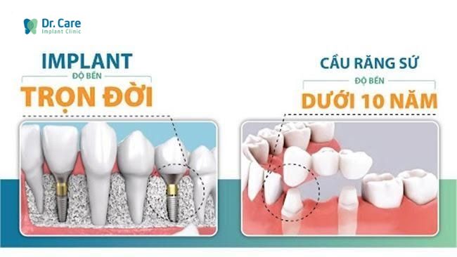 Thực hiện trồng răng Implant thay cho phương pháp cầu răng sứ