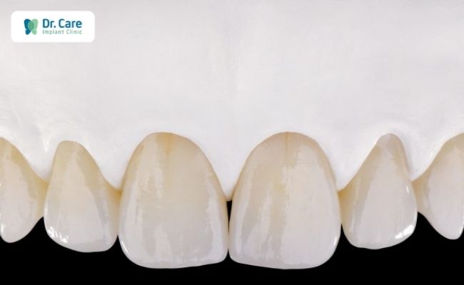 Răng sứ kim loại có tốt không?