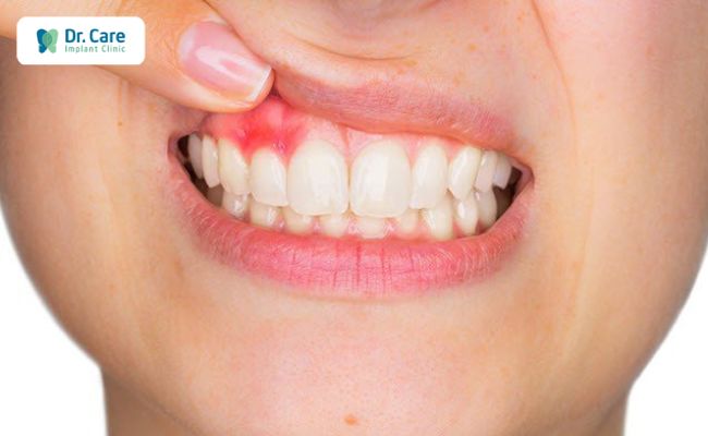 Những biến chứng có thể xảy ra sau khi bọc răng sứ sai kỹ thuật