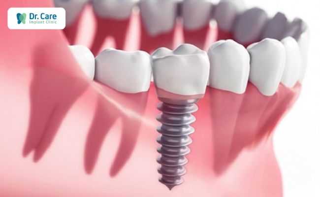 Trồng răng Implant khắc phục biến chứng bọc răng sứ