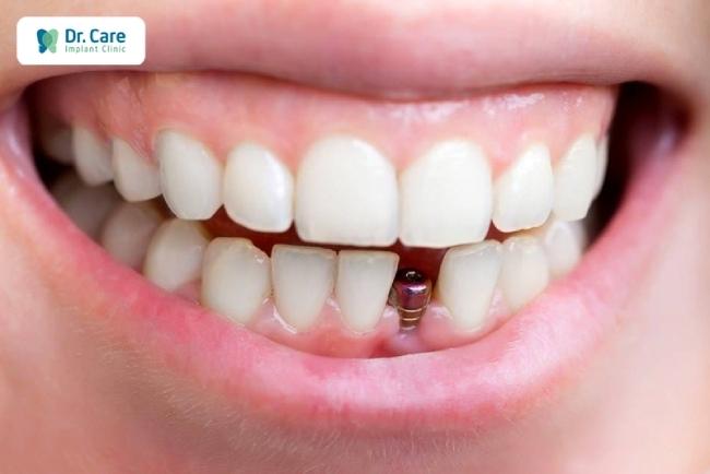 Lệch khớp cắn có thể tạo ra lực va chạm đột ngột, tác động đến răng Implant