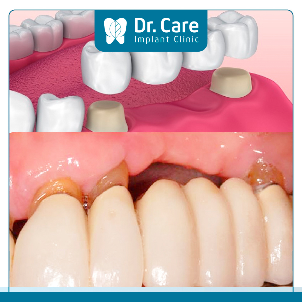 Trồng 3 răng liên tiếp bằng cách trồng răng sứ bắc cầu giúp khôi phục chức năng ăn nhai khoảng 70 – 80%