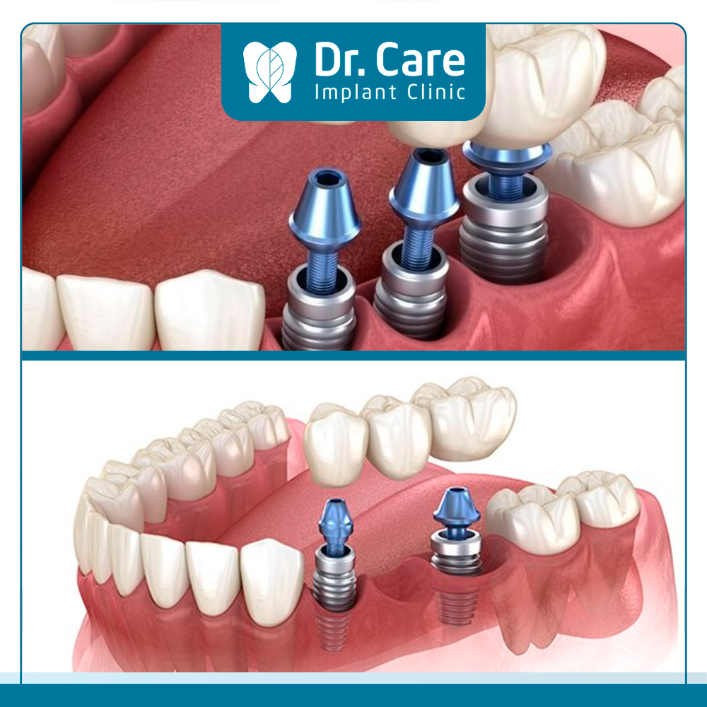 Trồng răng Implant khôi phục chức năng ăn nhai, tính thẩm mỹ cao khi mất 3 răng liên tiếp
