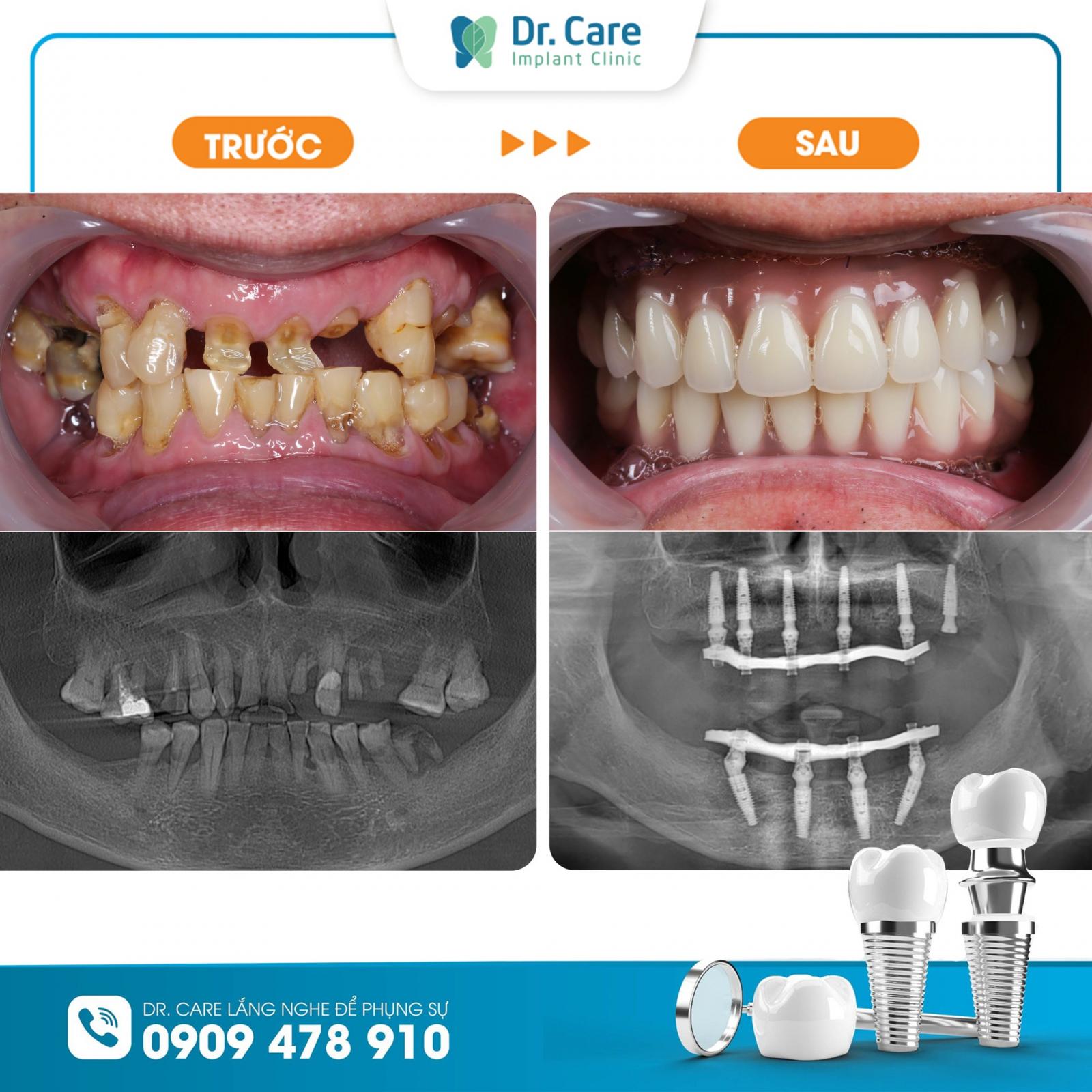 Khách hàng trồng răng Implant thành công tại Dr. Care