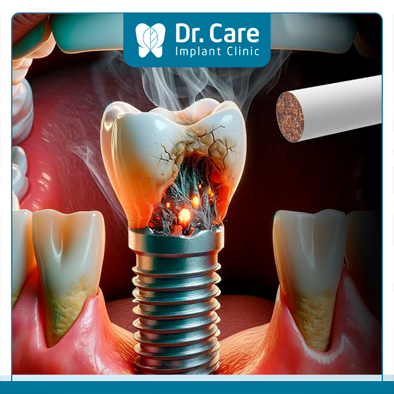 Nguyên nhân hút thuốc lá ảnh hưởng đến răng Implant 