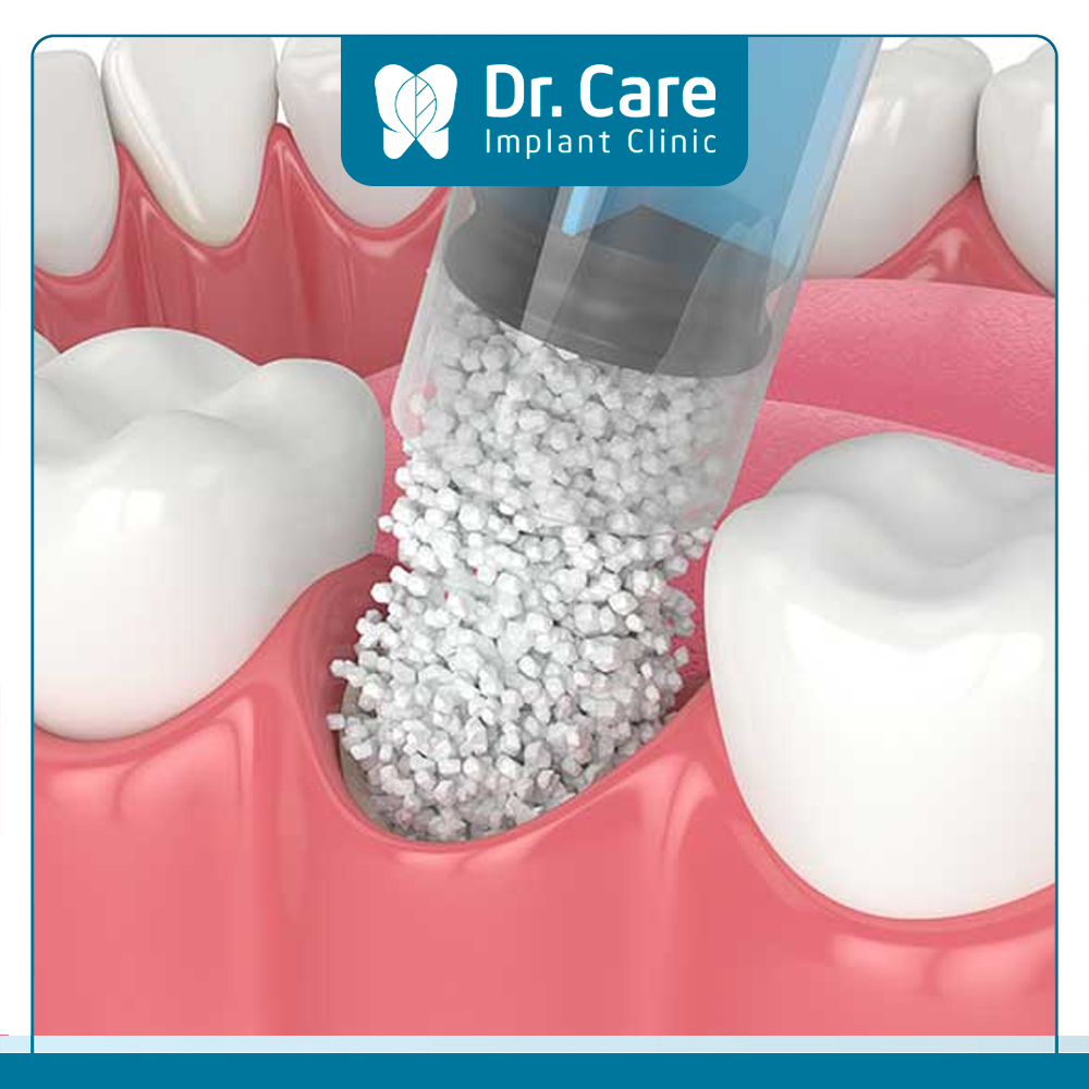 Đối tượng chống chỉ định ghép xương khi trồng răng Implant