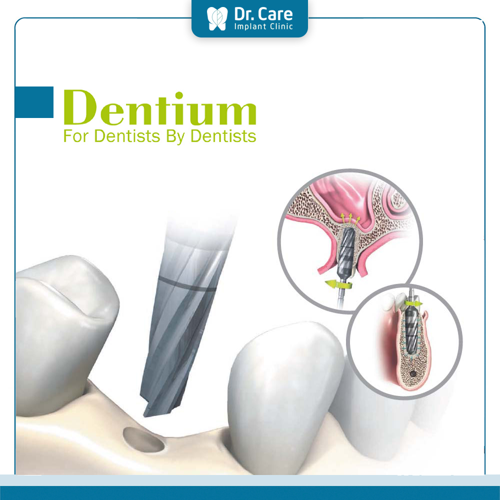 Hạn chế của trụ Implant Dentium Hàn Quốc