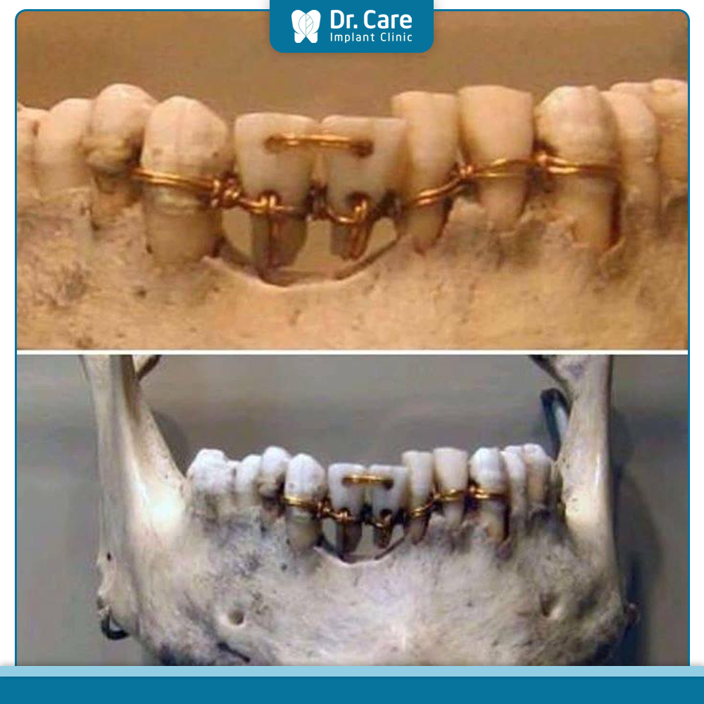 Những trường hợp cấy ghép răng Implant đầu tiên trong lịch sử