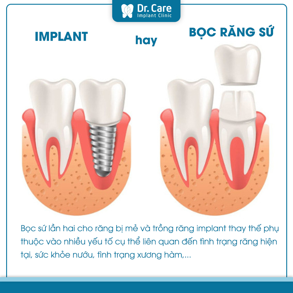Răng sứ bị mẻ nên bọc sứ lần 2 hay trồng răng Implant thay thế?