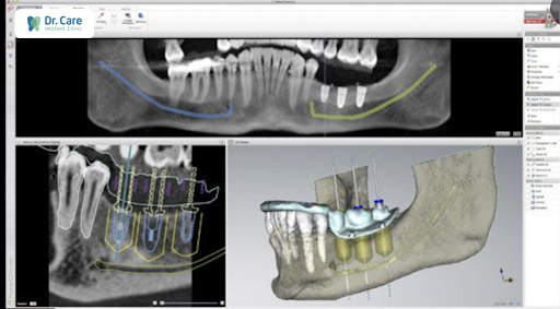 Phần mềm Nobel Clinician tại Dr. Care xác định rõ vị trí implant để đạt được sự bền vững lâu dài nhất cho khách hàng.