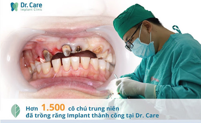 Hơn 1.500 khách hàng đã lựa chọn trồng răng Implant thành công tại Dr. Care