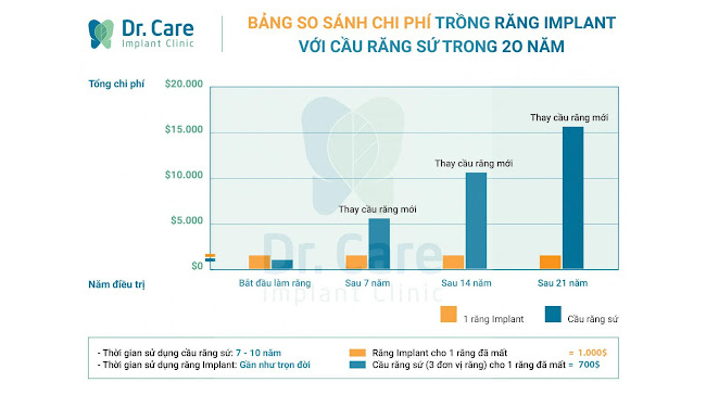 Bảng so sánh chi phí trồng răng Implant và cầu răng sứ