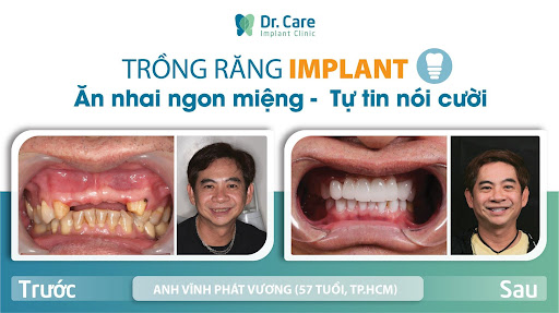 Trồng răng Implant